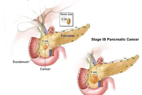 Bild: Biologische Krebstherapie beim Pankreaskarzinom – Immunaufbau und Apoptose durch Zelltherapie