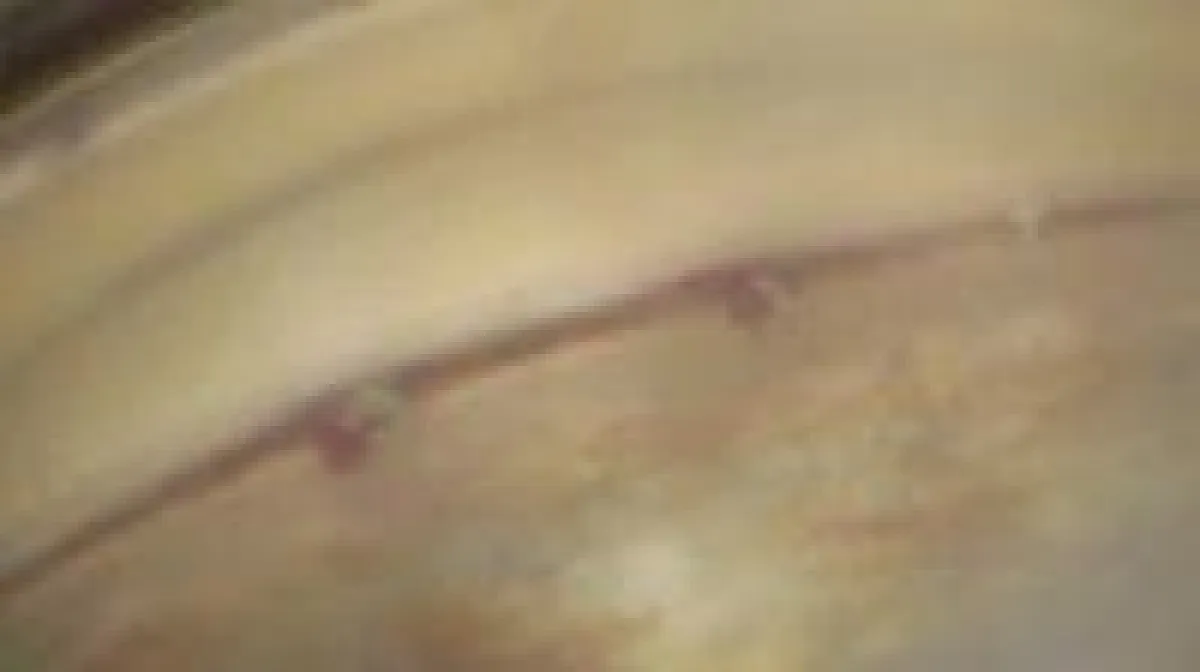 Implantation von zwei i-Stents in den Kammerwinkel, leichte Blutreflux bestätigt die korrekte Lage der i-Stents