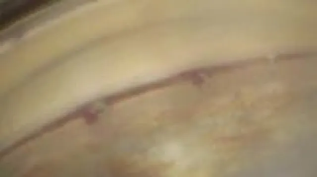 Bild: Erste i-Stent-W-Implantation in Bayern