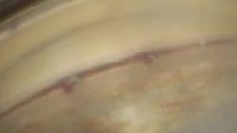 Bild: Erste i-Stent-W-Implantation in Bayern