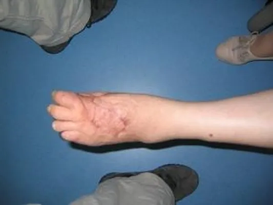 Bild: Hyperbare Sauerstofftherapie, eine große Chance zur Wundheilung beim Diabetischen Fuß