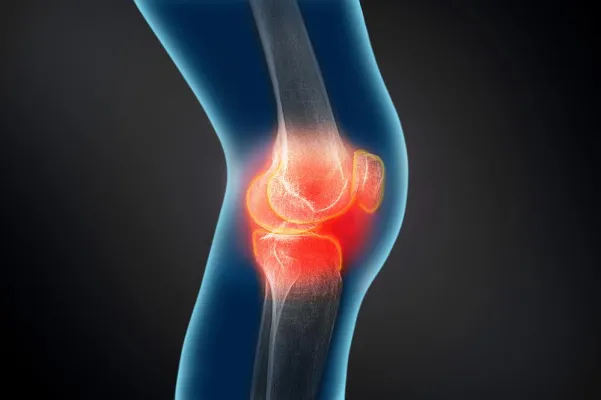 Bild: Einladung zum Arthrosetag im Knappschaftskrankenhaus