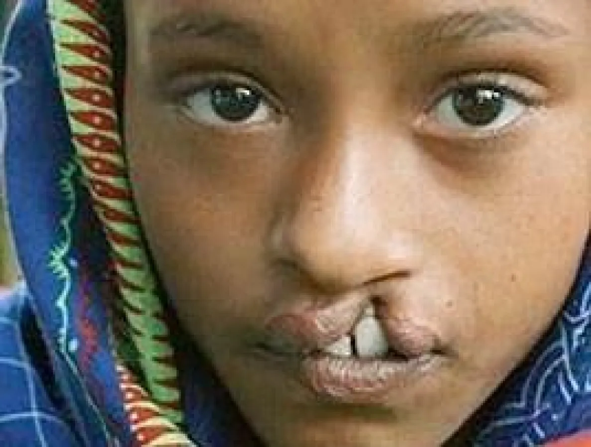 Die Wohltätigkeitsorganisation Operation Smile und Xango geben Kindern ihr Lachen zurück