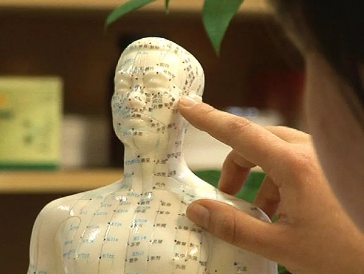 Akupunktur kann als ergänzende Behandlung bei MS helfen