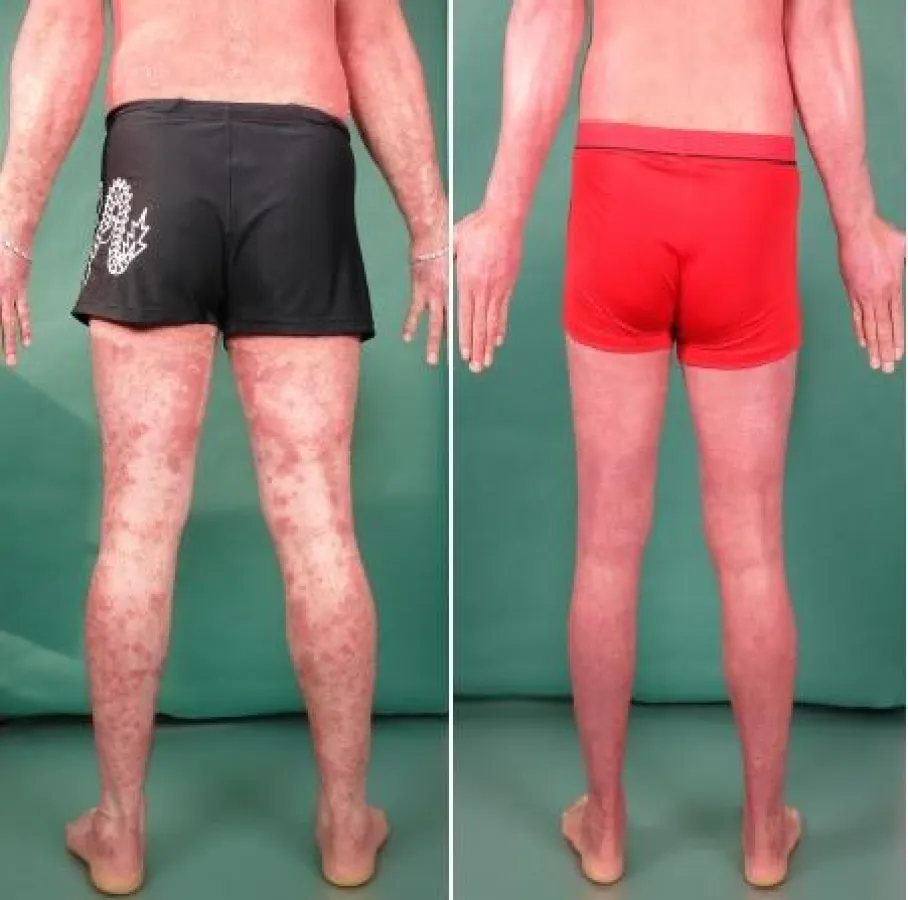 Psoriasis vor und nach DermoDyne® Lichtimpfung® (12 Sitzungen)