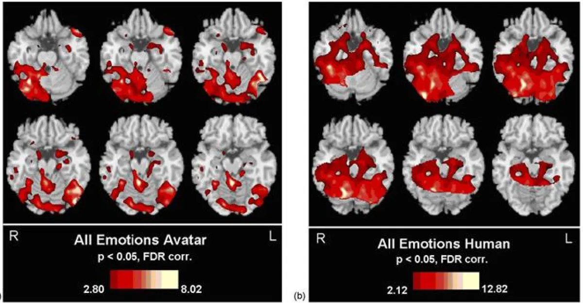 Bilder einer ANOVA-Analyse, die die Aktivierung der funktionellen Aktivität unterschiedlicher anatomischen Regionen untersucht.