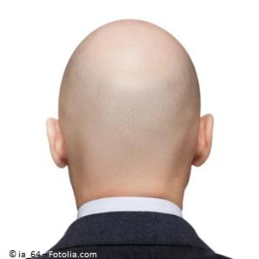 Haartransplantation oder ein Kopfhaut-Tattoo als Alternative zur Glatze / © ia_64 – Fotolia.com
