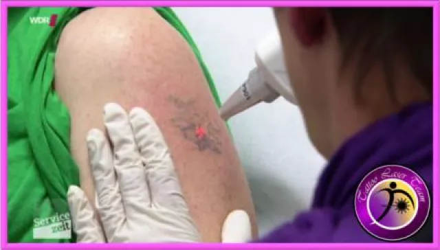 Bild: Fakten zur Laser Tattooentfernung