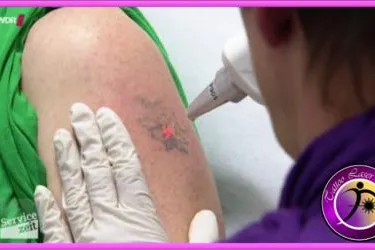 Fakten zur Laser Tattooentfernung Bild: Fakten zur Laser Tattooentfernung