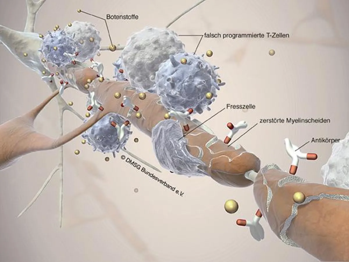 (Foto: DMSG Bundesverband e. V.) Fehlerhaft programmierten T-Zellen gelingt der Übergang in das zentrale Nervensystem. Gemeinsam mit den Fresszellen zerstören sie die Myelinscheiden, sodass die Nerven