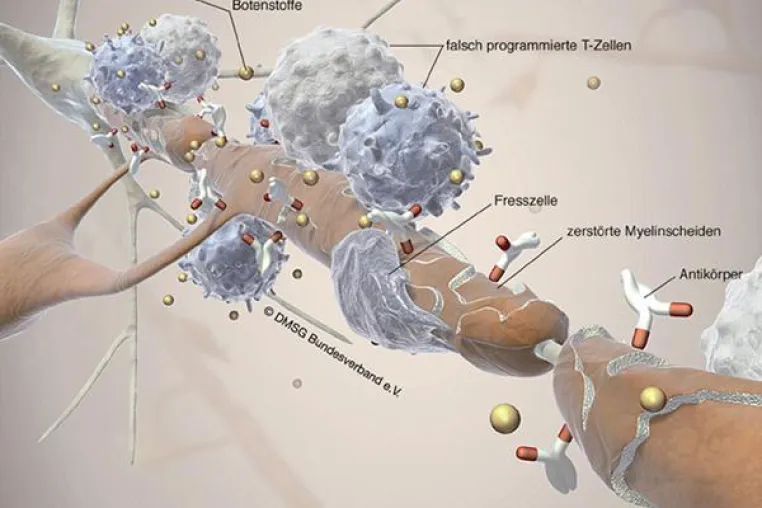 Diagnose "unheilbar" – ein Leben mit Multipler Sklerose Bild: Diagnose "unheilbar" – ein Leben mit Multipler Sklerose
