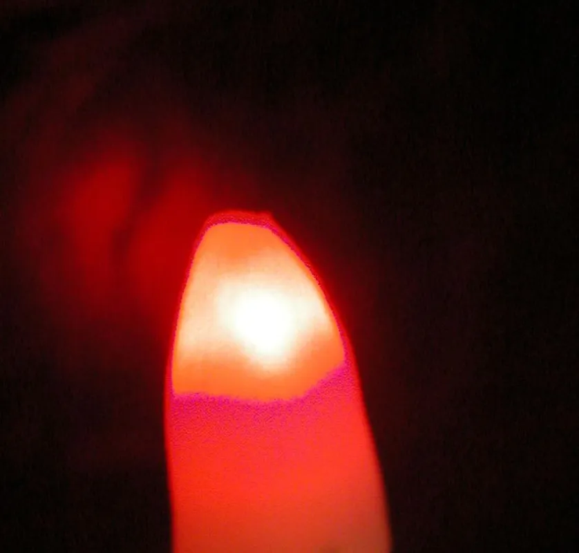 Laserlicht  an der Wurzelspitze