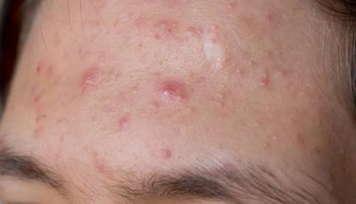 Hautprobleme wie Akne und Rosacea gehören in die Hände von Spezialisten