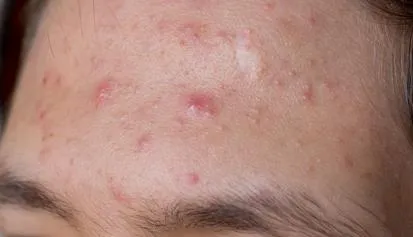 Bild: Fachkosmetik kann bei Akne und Rosacea langfristig helfen