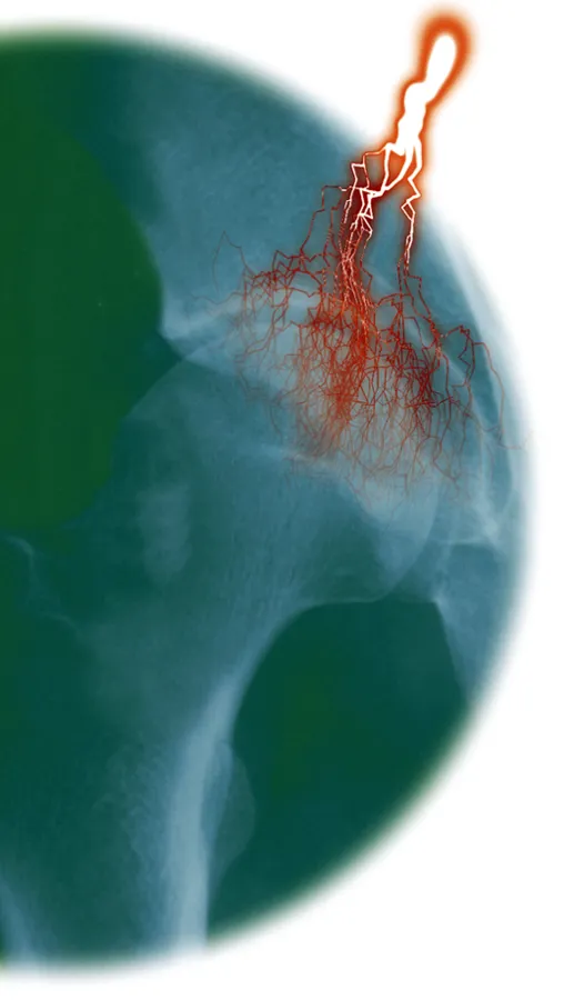 Arthroseschmerzen müssen nicht sein: ein neues Medikament macht Hoffnung