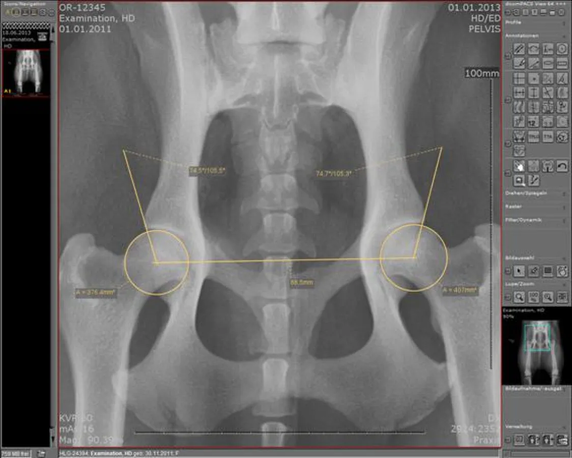 Abb.: HD-Vermessung mit Norbergwinkel.