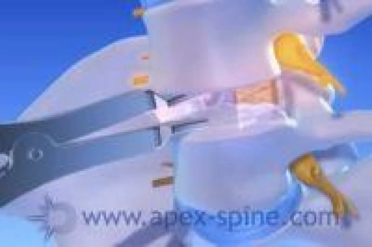 Apex-Spine Bandscheibenprothese