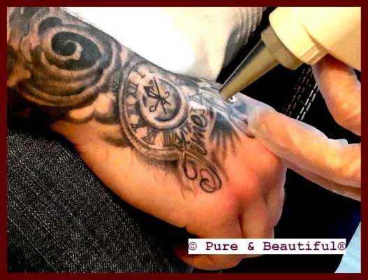 Bild: Steigt der Wunsch nach Tattooentfernung? Laserexperten geben Antwort.