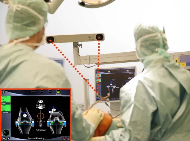 Weltweit erstmals Knierevision mittels Computerhilfe Bild: Weltweit erstmals Knierevision mittels Computerhilfe