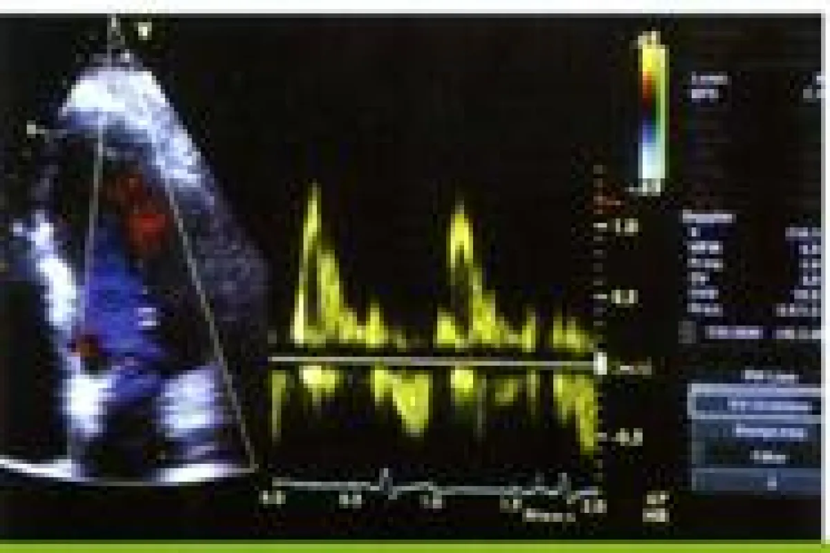 Monitor mit Herzkurve