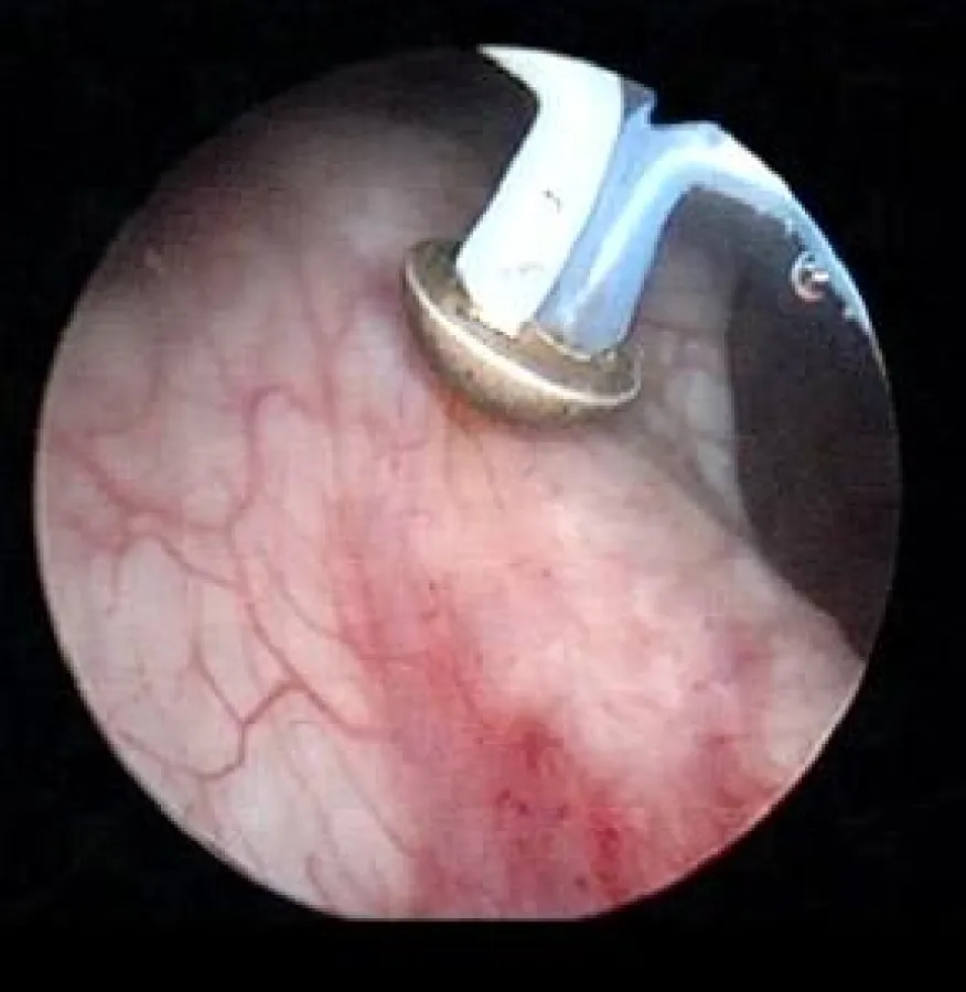 Die hochmoderne Plasma-Vaporisationselektrode der Firma Olympus verdampft das Gewebe besonders schonend und blutungsarm