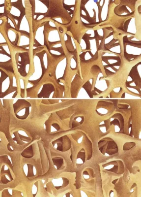 Bild: Kortikoidinduzierte Osteoporose: Risiko minimieren