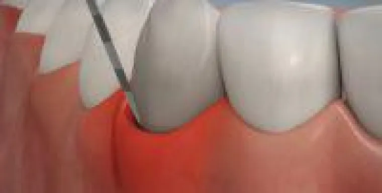 Bild: Zahnfleischbluten: Ursachen, Behandlung und Vorbeugung.