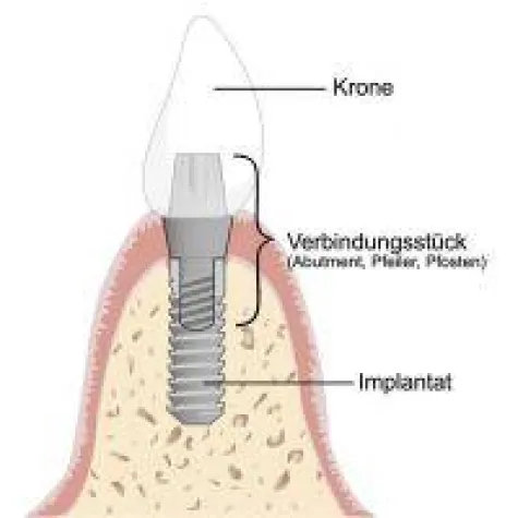Bild: Zahnimplantate im Alter, lohnt sich das noch?