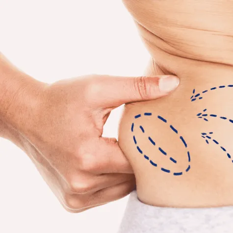 Bild: Fettabsaugung: Präzision statt radikale Diät