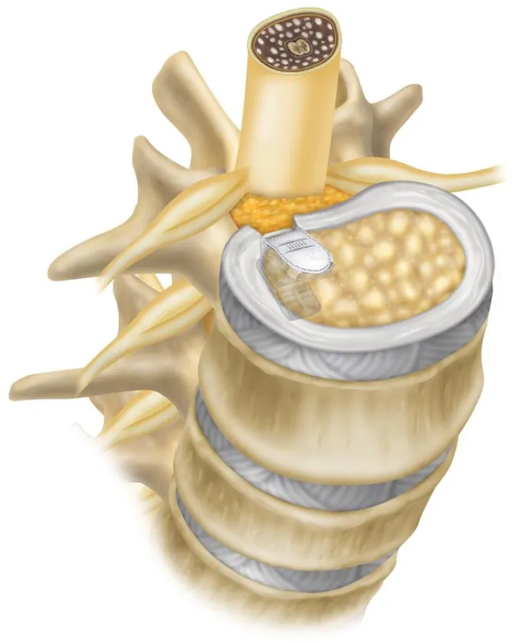 Grafik zum Einsatz des Implantat Barricaid®