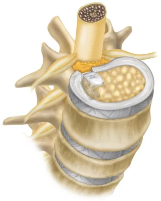 Neue Studie zu einer innovativen Operationsmethode: Reoperationen nach Bandscheibenvorfallen um 50% gesenkt Bild: Neue Studie zu einer innovativen Operationsmethode: Reoperationen nach Bandscheibenvorfallen um 50% gesenkt