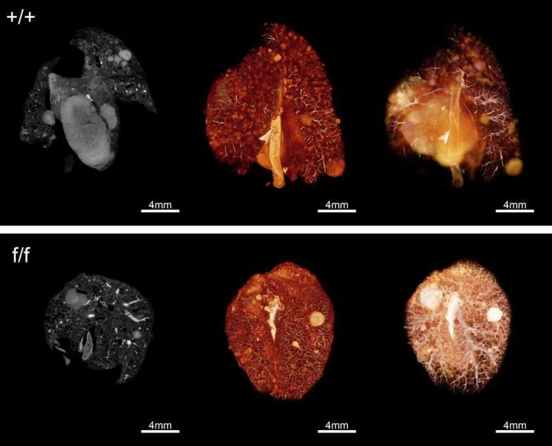 Bei der Behandlung von Lungentumoren mit Denosumab (untere Reihe: RANK/RANKL wurde blockiert, oberen Reihe: Signalweg ist aktiv) konnte ein Fortschreiten der Krankheit signifikant verringert werden ((