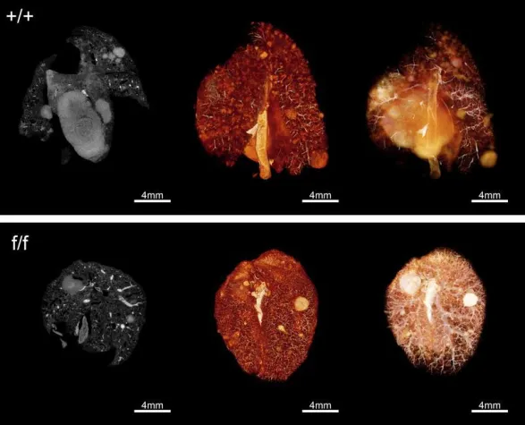 Frauen und Lungenkrebs – Lang vermuteter Zusammenhang erstmals aufgedeckt Bild: Frauen und Lungenkrebs – Lang vermuteter Zusammenhang erstmals aufgedeckt