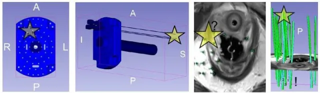 Katheterpfade für die interne Strahlentherapie bestmöglich präzisieren Bild: Katheterpfade für die interne Strahlentherapie bestmöglich präzisieren