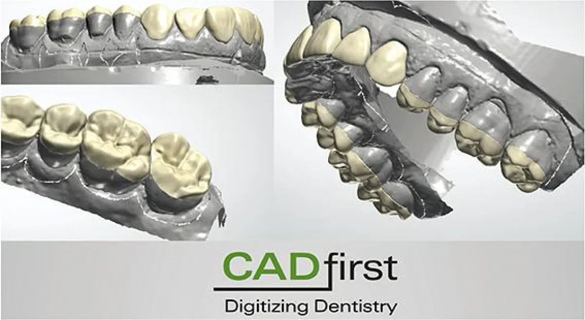 CAD/CAM gefertigte Kauflächenveneers