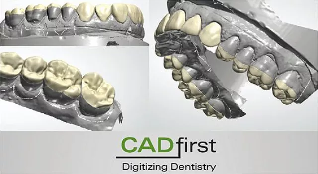 Bild: Mit Kauflächen-Veneers die Okklusion optimieren