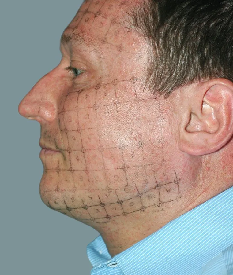 Für die Schönheit hinter Gitter: Beim Thermage-Verfahren teilt ein abwaschbares Raster das Gesicht des Patienten in Behandlungszonen ein.