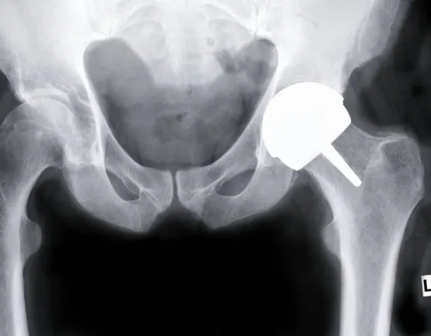 Bild: Gelenkersatz - Ärzte Symposium in Hamburg