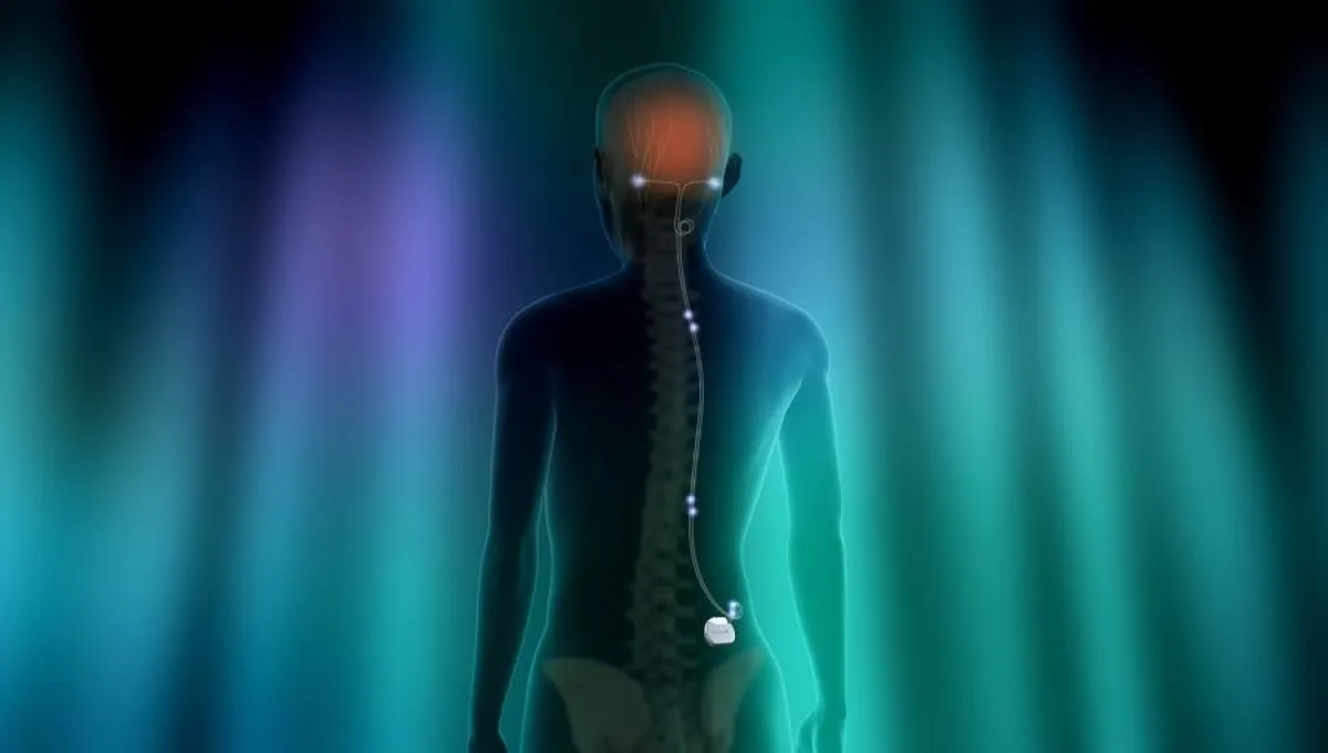 Bei chronischer Migräne schafft die Periphere Neurostimulation oft Abhilfe