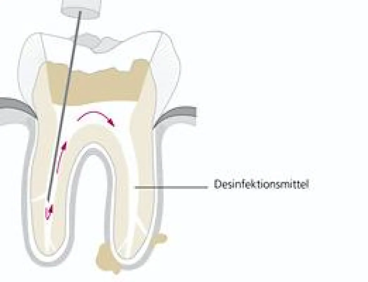 Der Erfolg einer Zahnwurzelbehandlung hängt auch von einer ausreichenden Desinfektion ab.