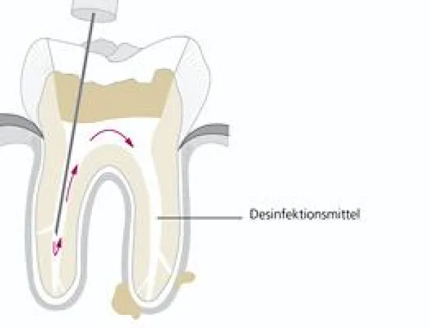 Bild: Zahnwurzelbehandlung im Eilverfahren