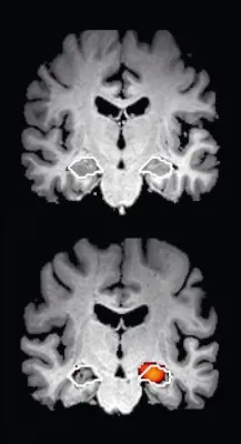 Bild: Neue Studie spricht für frühzeitige Alzheimerdiagnostik