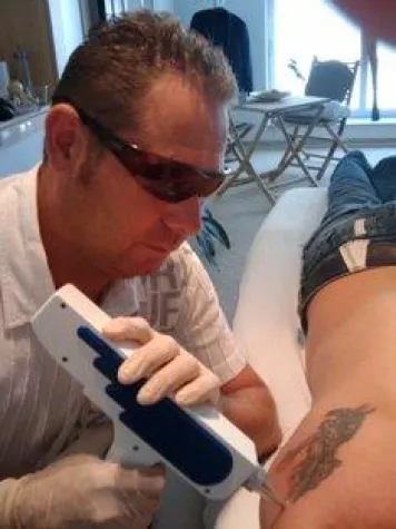 Bild: Tattooentfernung