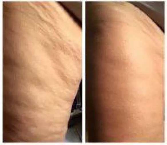 Der Name ByeByeCellulite sagt alles über die Wirkung der Creme Bild: Der Name ByeByeCellulite sagt alles über die Wirkung der Creme