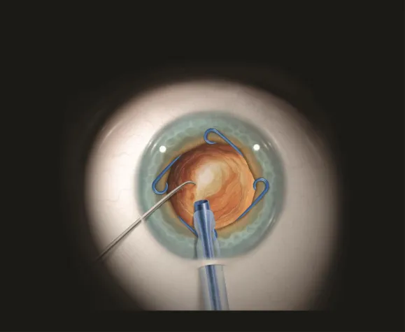 Bild: Übernahme des Exklusiv-Vertrieb der MST-Produkte durch die Polytech Ophthalmologie GmbH