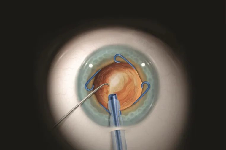 Bild: Übernahme des Exklusiv-Vertrieb der MST-Produkte durch die Polytech Ophthalmologie GmbH
