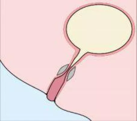 Bild: UROLASTIC: Neues Verfahren bei Blasenschwäche zeigt dauerhaften Wirkeffekt