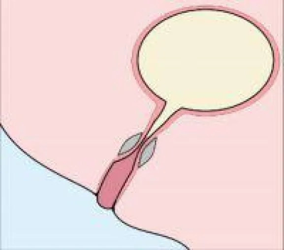 UROLASTIC: Neues Verfahren bei Blasenschwäche zeigt dauerhaften Wirkeffekt Bild: UROLASTIC: Neues Verfahren bei Blasenschwäche zeigt dauerhaften Wirkeffekt
