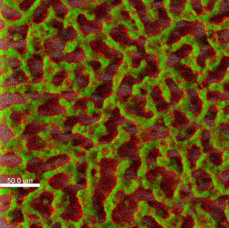 Biofilm eines klinischen Isolates von Pseudomonas aeruginosa in der Fluoreszenzfärbung (grün: lebende Zellen, rot: tote Zellen) (TWINCORE/Janne Thöming)