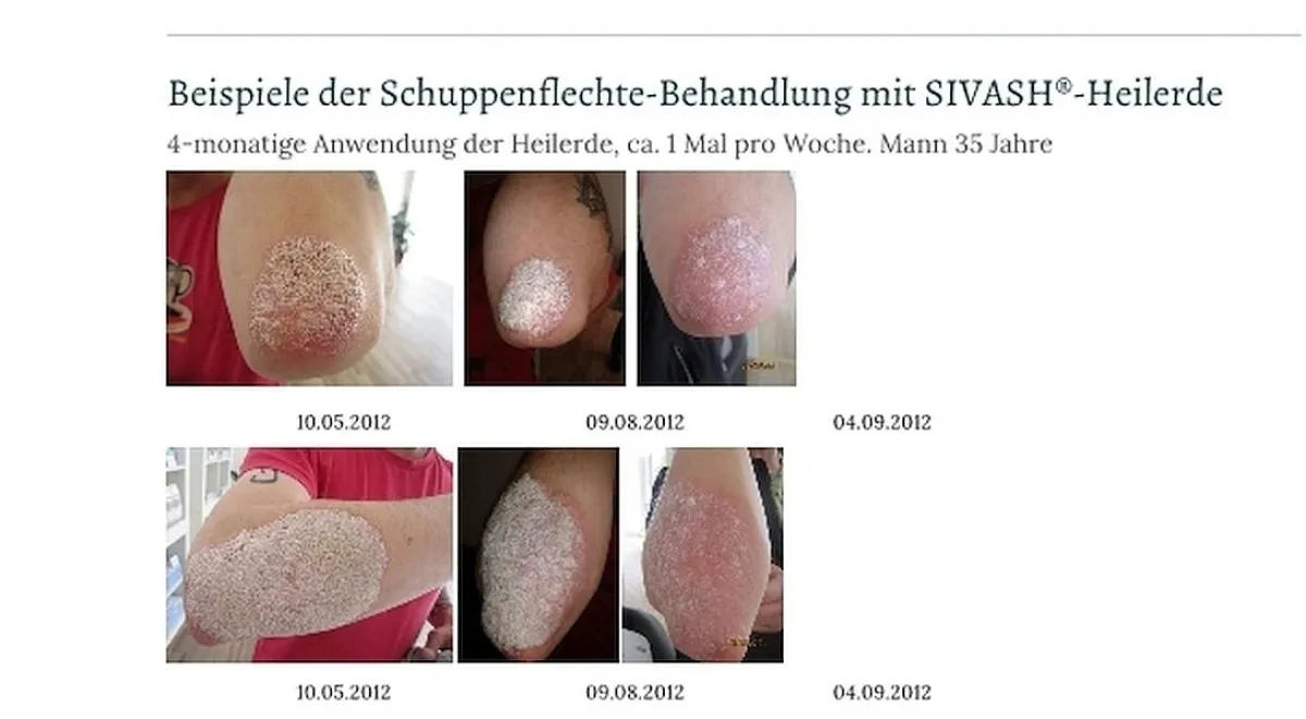 Beispiel einer Behandlung von Psoriasis mit Sivash-Heilerde
